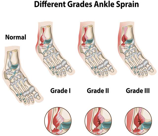 Ankle Sprain